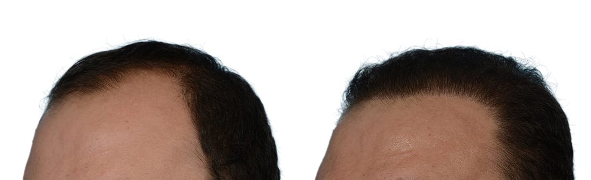 Hair Restoration Before & After Gallery - Patient 252336 - Image 2