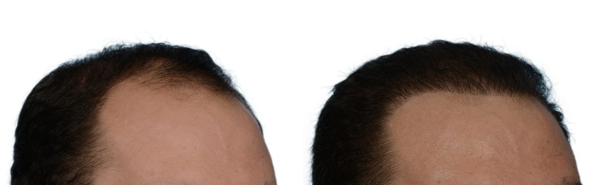 Hair Restoration Before & After Gallery - Patient 252336 - Image 3