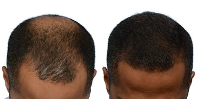Hair Restoration Before & After Gallery - Patient 419850 - Image 1