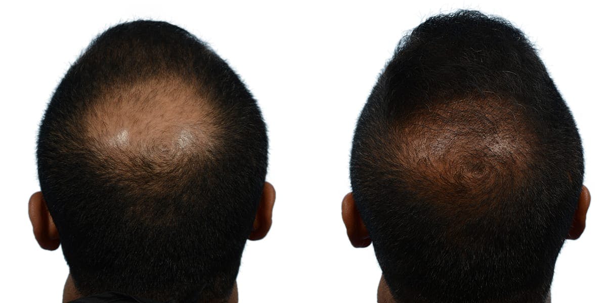 FUE Hair Transplant Before & After Gallery - Patient 597194 - Image 2