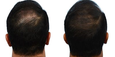 FUE Hair Transplant Before & After Gallery - Patient 596702 - Image 1