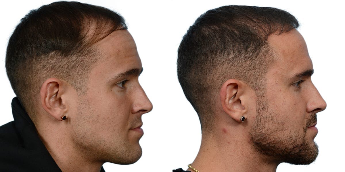 FUE Hair Transplant Before & After Gallery - Patient 284621 - Image 2