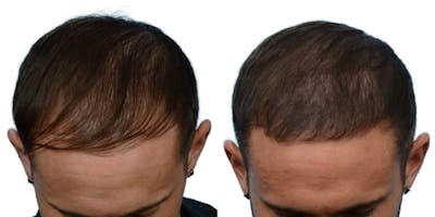 FUE Hair Transplant Before & After Gallery - Patient 284621 - Image 1