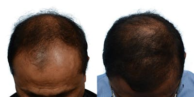 FUE Hair Transplant Before & After Gallery - Patient 406965 - Image 1