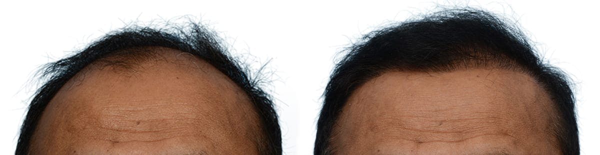 Hair Restoration Before & After Gallery - Patient 731786 - Image 2