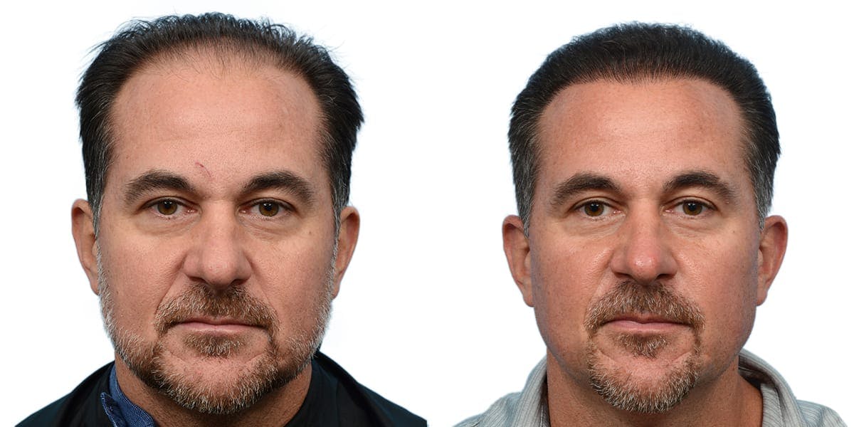 Hair Restoration Before & After Gallery - Patient 213579 - Image 2
