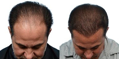 FUE Hair Transplant Before & After Gallery - Patient 532011 - Image 1