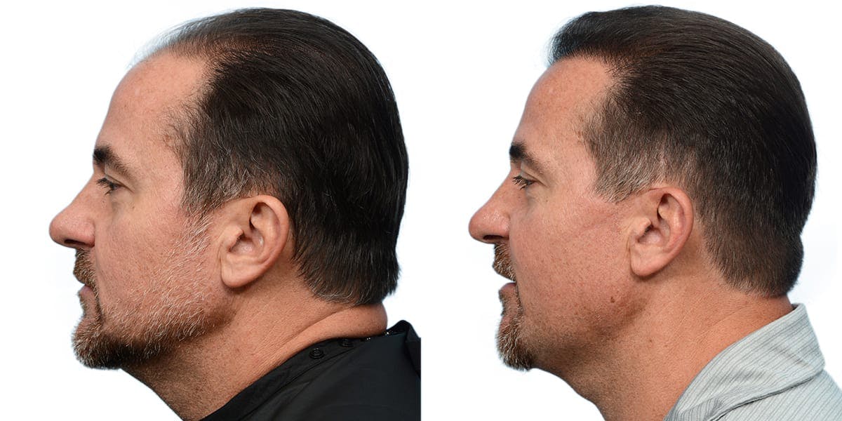 FUE Hair Transplant Before & After Gallery - Patient 532011 - Image 3