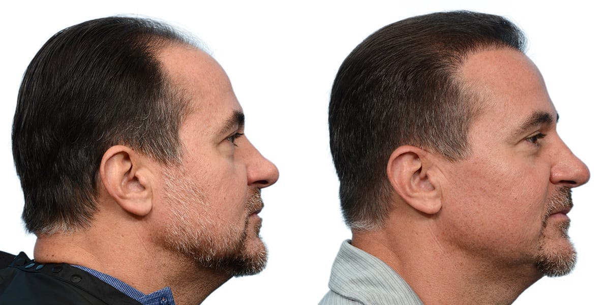 FUE Hair Transplant Before & After Gallery - Patient 532011 - Image 4
