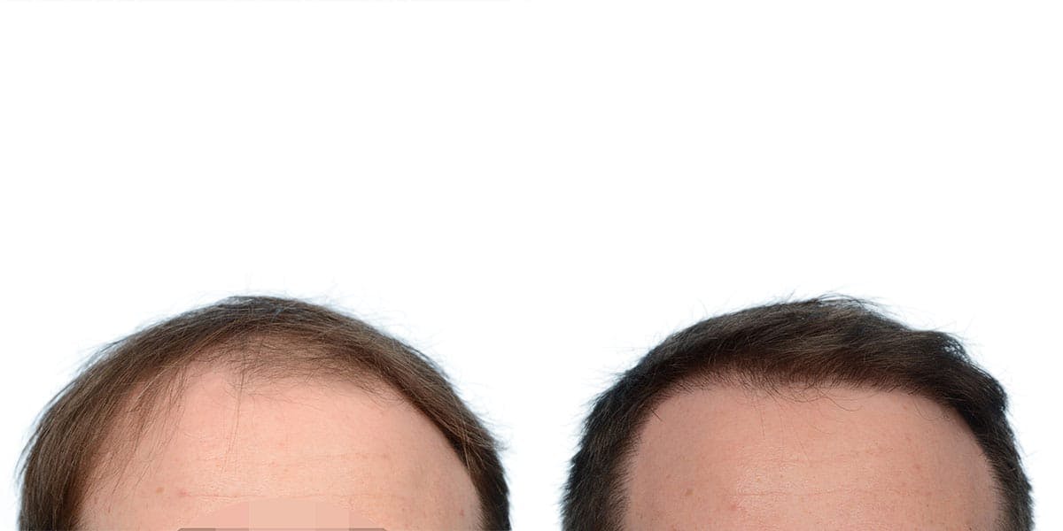 FUE Hair Transplant Before & After Gallery - Patient 102352 - Image 2
