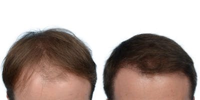 FUE Hair Transplant Before & After Gallery - Patient 102352 - Image 1