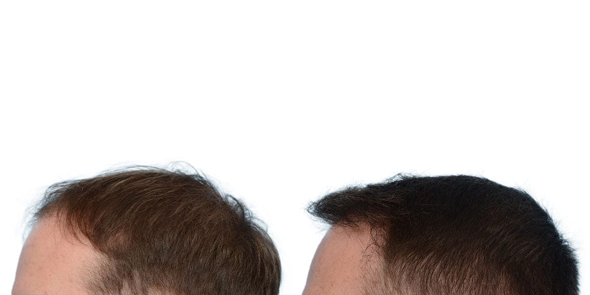 Hair Restoration Before & After Gallery - Patient 341682 - Image 3