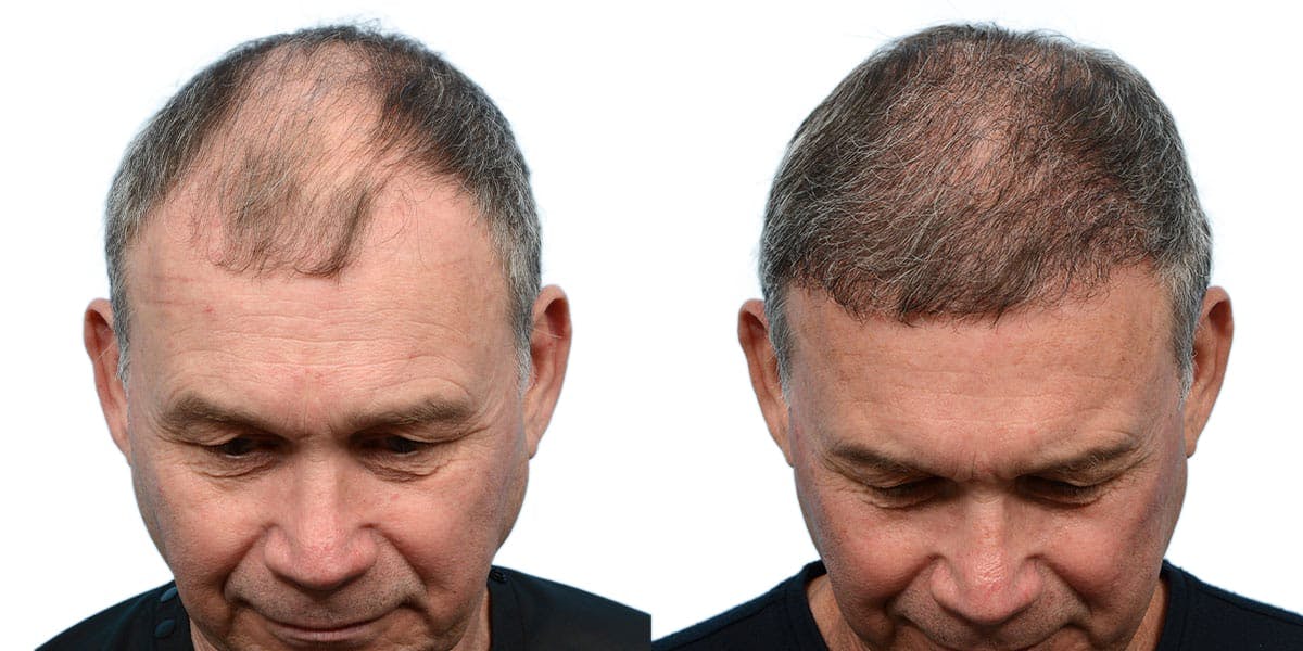 FUE Hair Transplant Before & After Gallery - Patient 150055 - Image 1