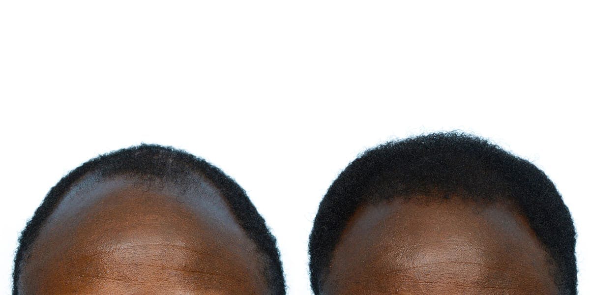 Hair Restoration Before & After Gallery - Patient 701318 - Image 2