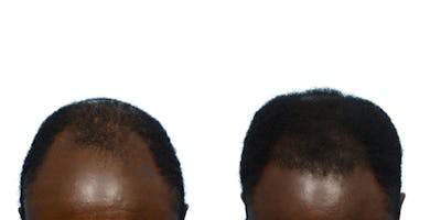 FUE Hair Transplant Before & After Gallery - Patient 342885 - Image 1