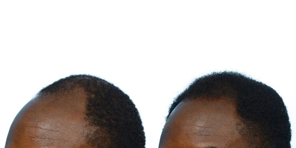 FUE Hair Transplant Before & After Gallery - Patient 342885 - Image 3