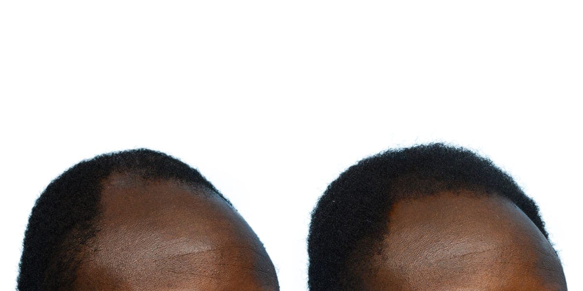 Hair Restoration Before & After Gallery - Patient 701318 - Image 4