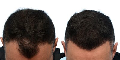 Hair Restoration Before & After Gallery - Patient 316587 - Image 1