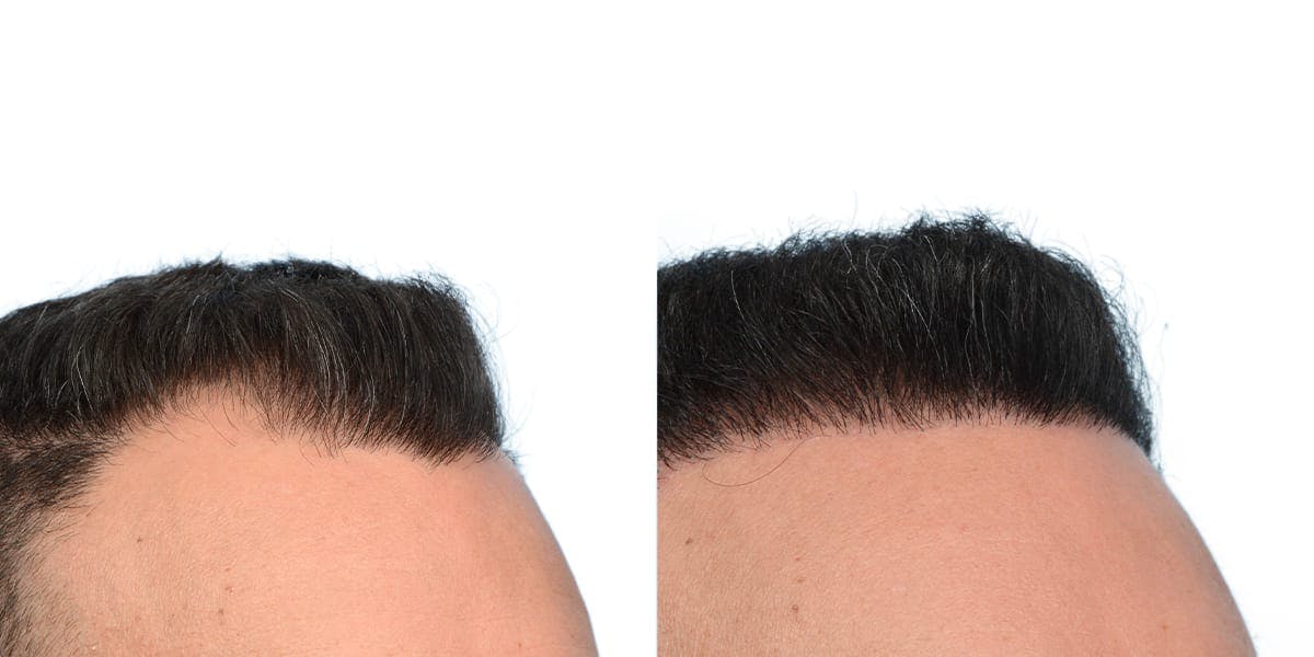 FUE Hair Transplant Before & After Gallery - Patient 339345 - Image 2