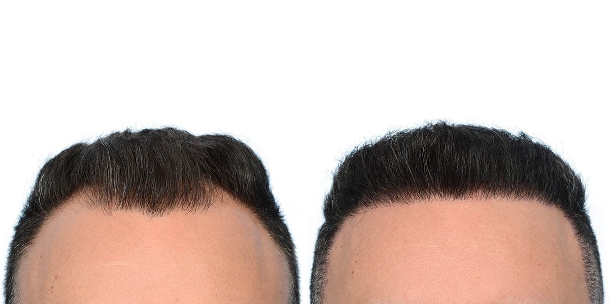 Hair Restoration Before & After Gallery - Patient 316587 - Image 3