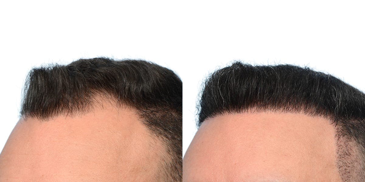 Hair Restoration Before & After Gallery - Patient 316587 - Image 4