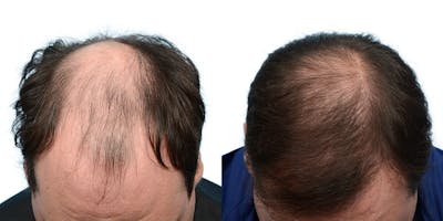 FUE Hair Transplant Before & After Gallery - Patient 724340 - Image 1