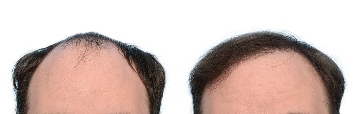 Hair Restoration Before & After Gallery - Patient 410592 - Image 2