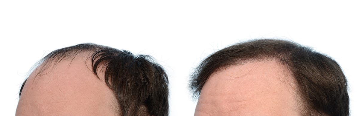 FUE Hair Transplant Before & After Gallery - Patient 724340 - Image 3