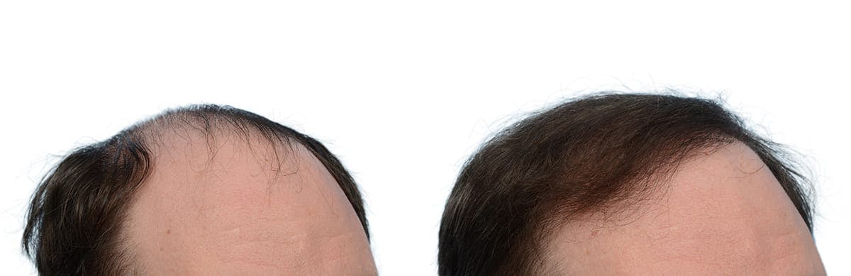 Hair Restoration Before & After Gallery - Patient 410592 - Image 4