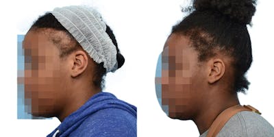 Hair Restoration Before & After Gallery - Patient 314070 - Image 1