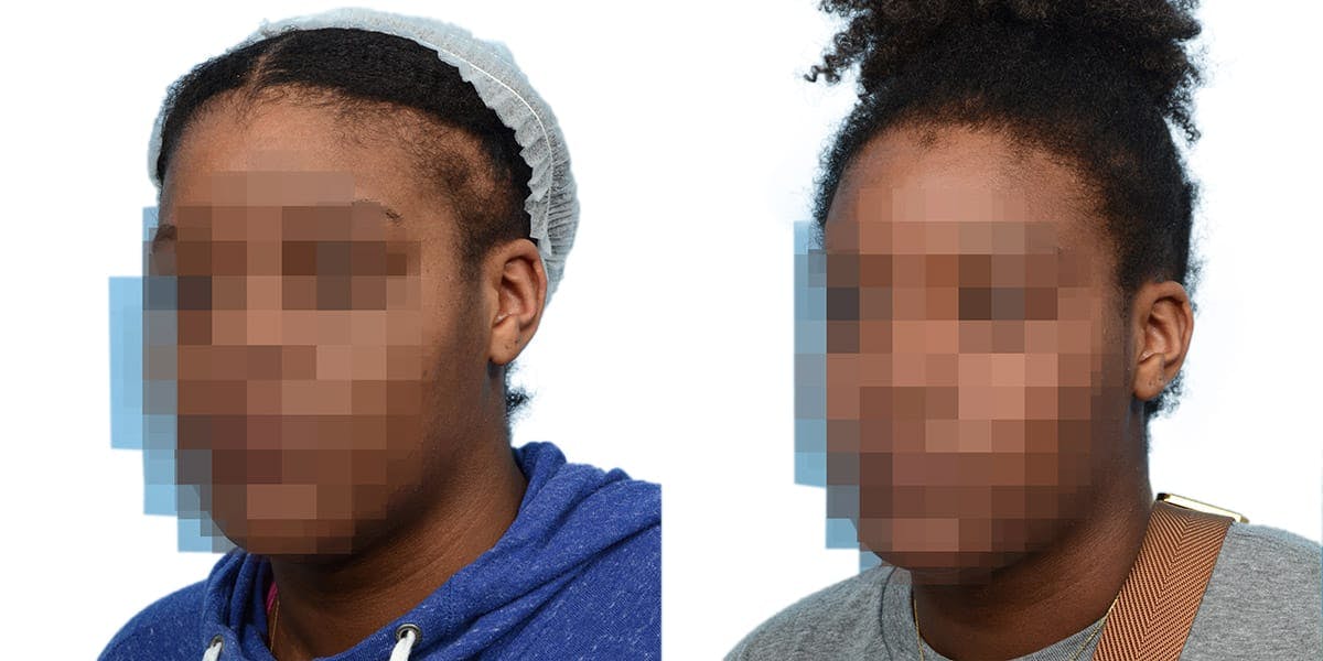 Hair Restoration Before & After Gallery - Patient 314070 - Image 2