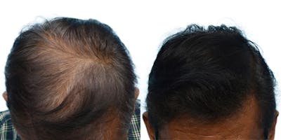 FUE Hair Transplant Before & After Gallery - Patient 114866 - Image 1