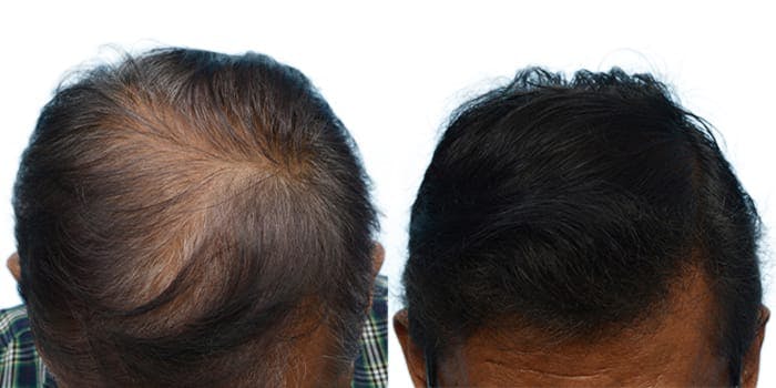 Hair Restoration  Before & After Gallery - Patient 185460 - Image 1