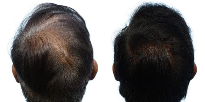 Hair Restoration  Before & After Gallery - Patient 185460 - Image 2