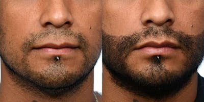 FUE Hair Transplant Before & After Gallery - Patient 352869 - Image 1