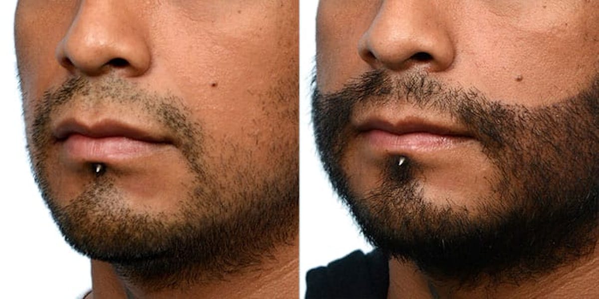 Facial Hair Transplant Before & After Gallery - Patient 212521 - Image 2