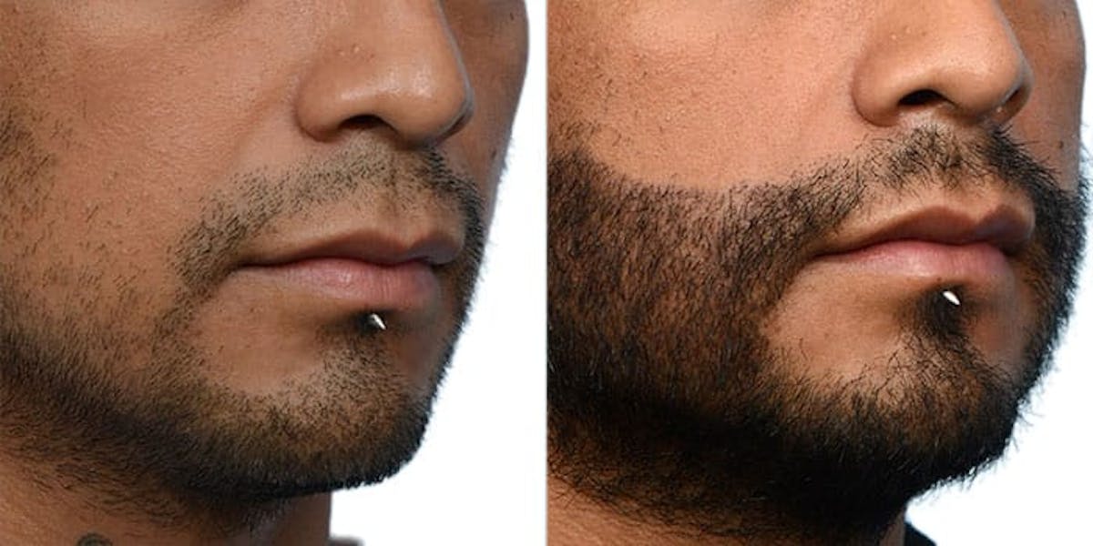 Facial Hair Transplant Before & After Gallery - Patient 212521 - Image 3