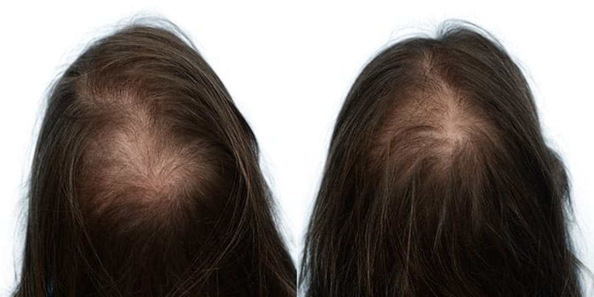 Female Hair Restoration Before & After Gallery - Patient 140748 - Image 1