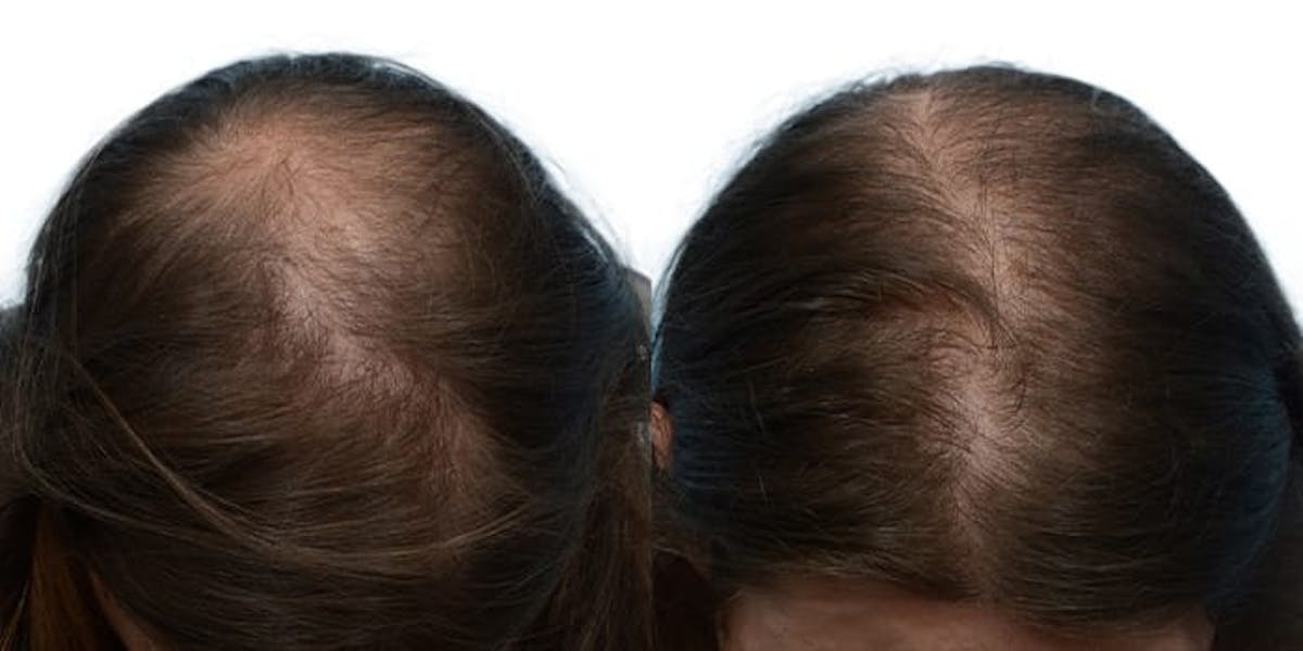 Female Hair Restoration Before & After Gallery - Patient 140748 - Image 2
