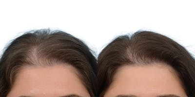 Hair Restoration Before & After Gallery - Patient 409502 - Image 1