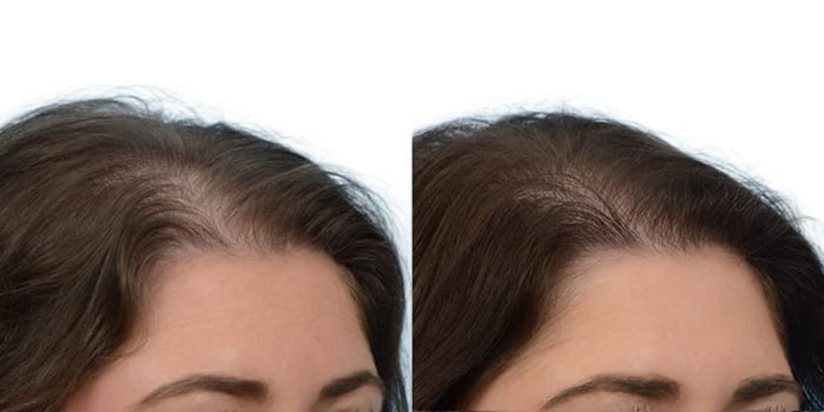 Hair Restoration Before & After Gallery - Patient 409502 - Image 2