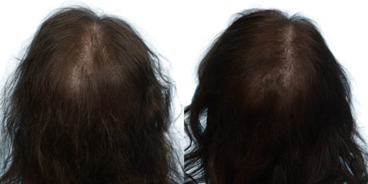 Female Hair Restoration Before & After Gallery - Patient 133504 - Image 3