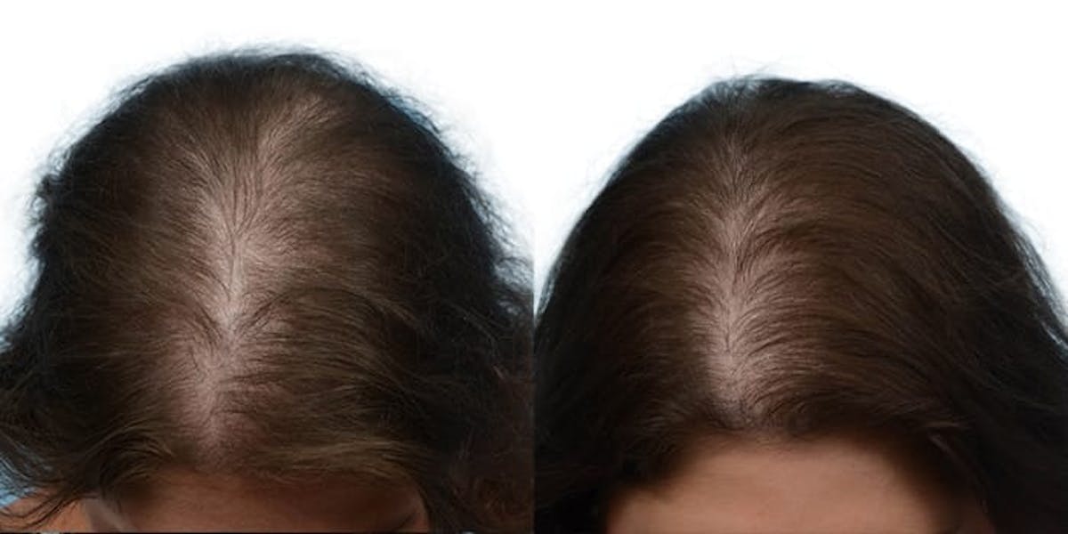 Female Hair Restoration Before & After Gallery - Patient 133504 - Image 4