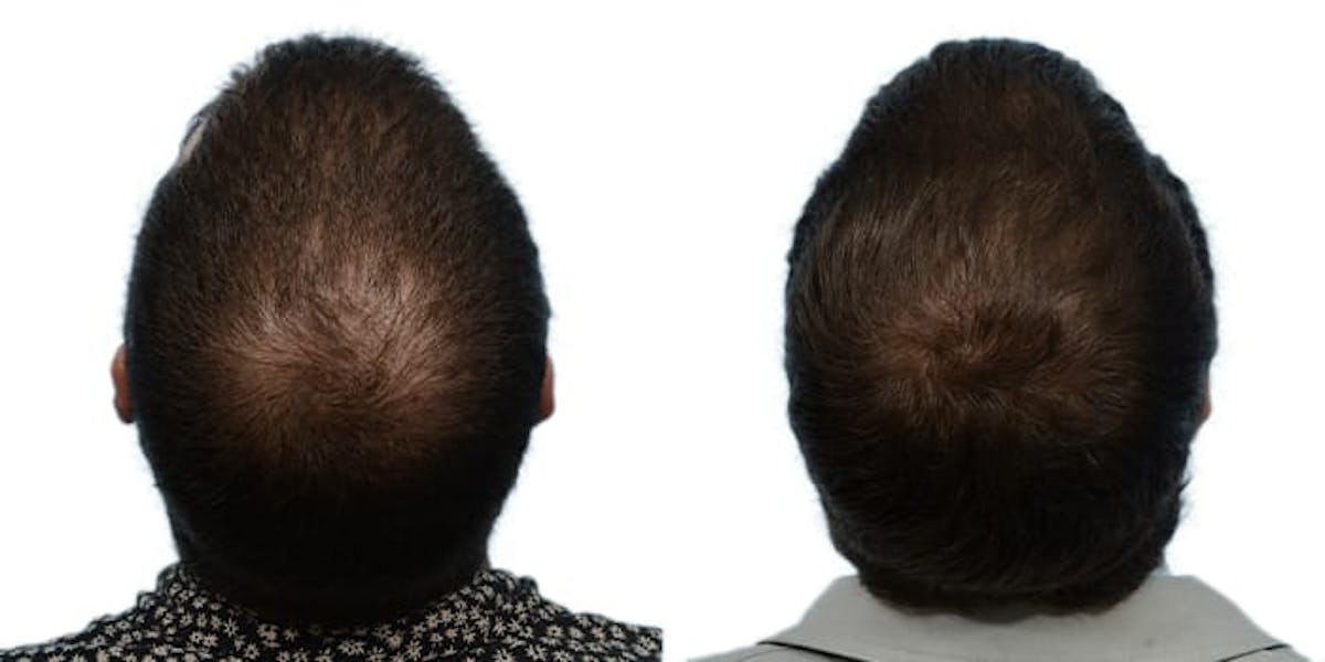 FUE Hair Transplant Before & After Gallery - Patient 320923 - Image 1