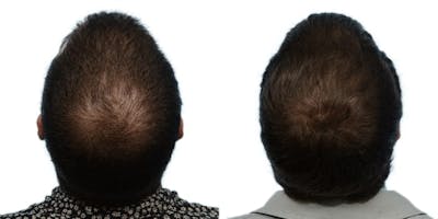 FUE Hair Transplant Before & After Gallery - Patient 320923 - Image 1