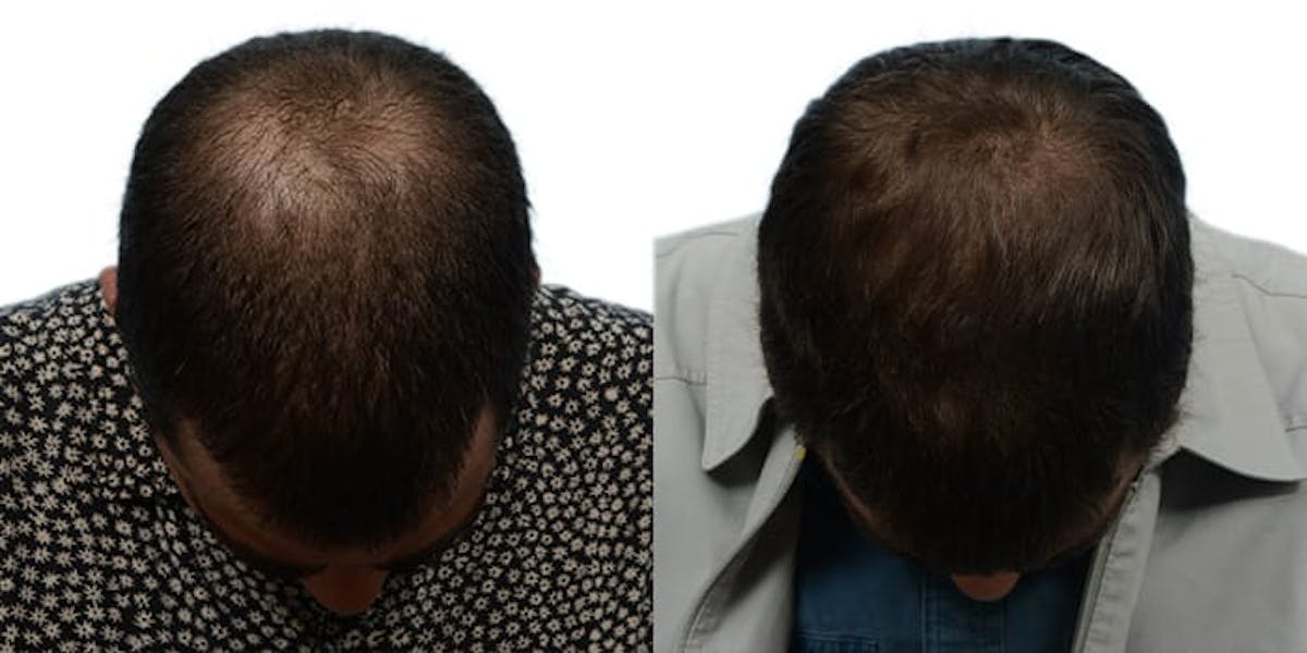 Hair Restoration Before & After Gallery - Patient 192374 - Image 2