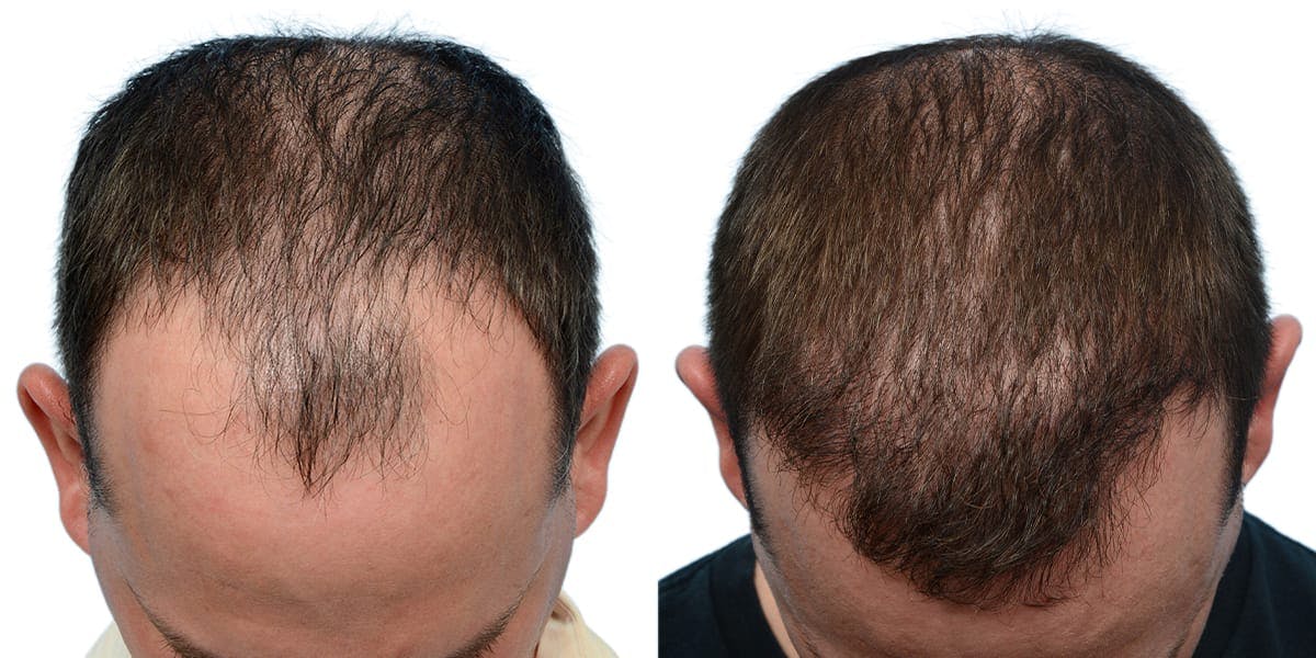 FUE Hair Transplant Before & After Gallery - Patient 363200 - Image 1