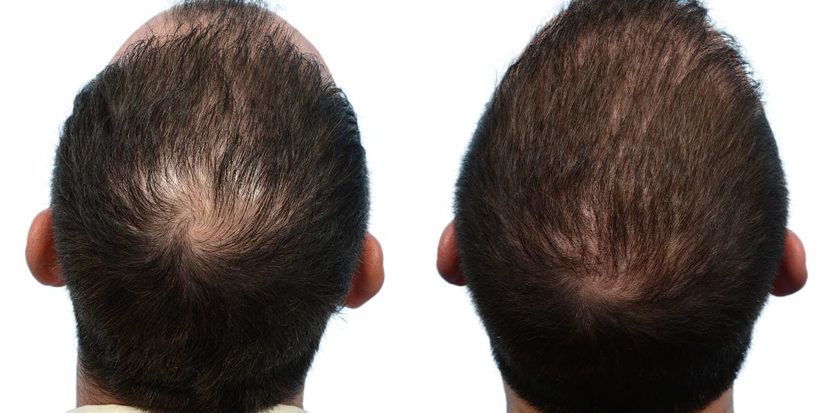 Hair Restoration Before & After Gallery - Patient 354572 - Image 2