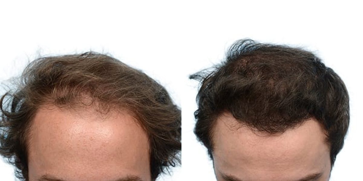 Hair Restoration Before & After Gallery - Patient 101786 - Image 1