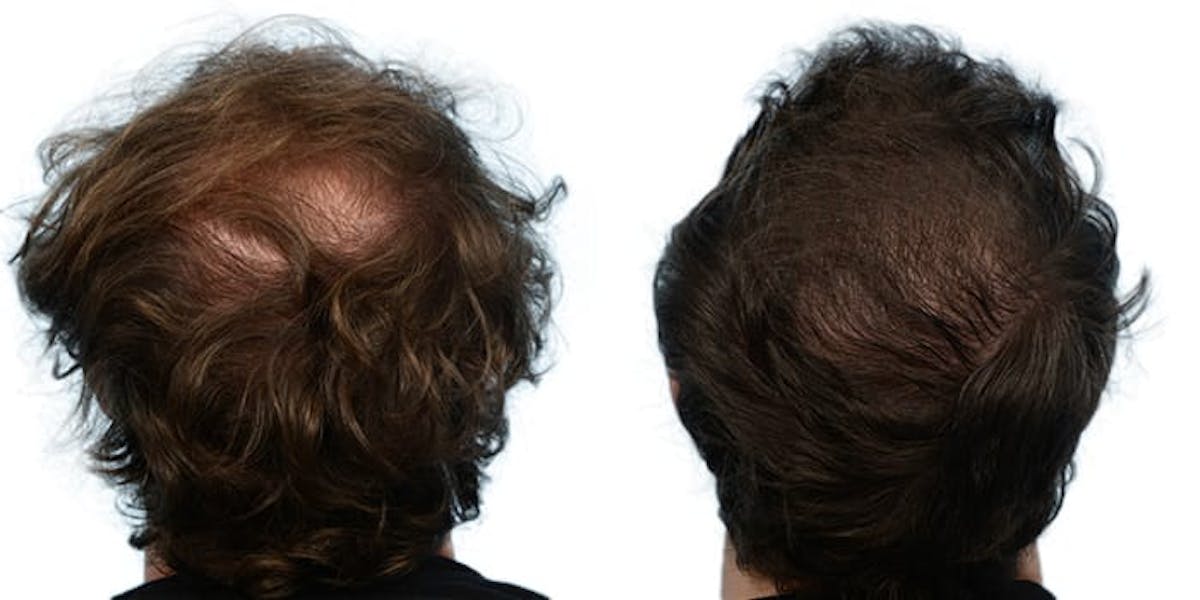 Hair Restoration Before & After Gallery - Patient 101786 - Image 2